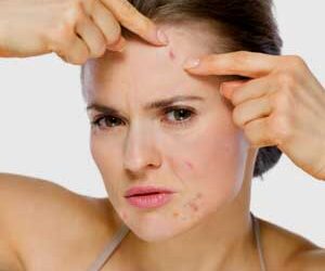 How Hormones Cause Adult Acne in Women